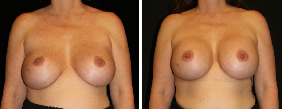 Breast Revision Before & After Gallery - Patient 205255 - Image 1
