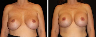 Breast Revision Before & After Gallery - Patient 205255 - Image 1