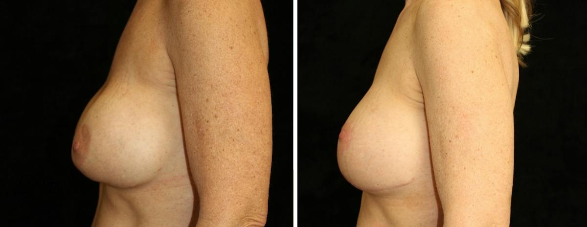 Breast Revision Before & After Gallery - Patient 116926 - Image 3