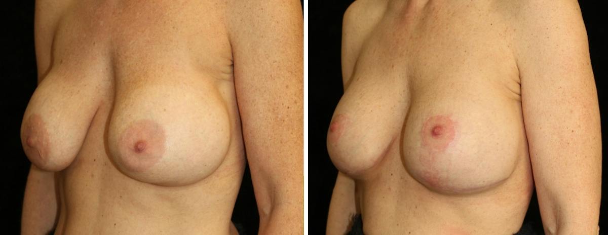 Breast Revision Before & After Gallery - Patient 116926 - Image 2