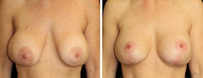 Breast Revision Before & After Gallery - Patient 116926 - Image 1