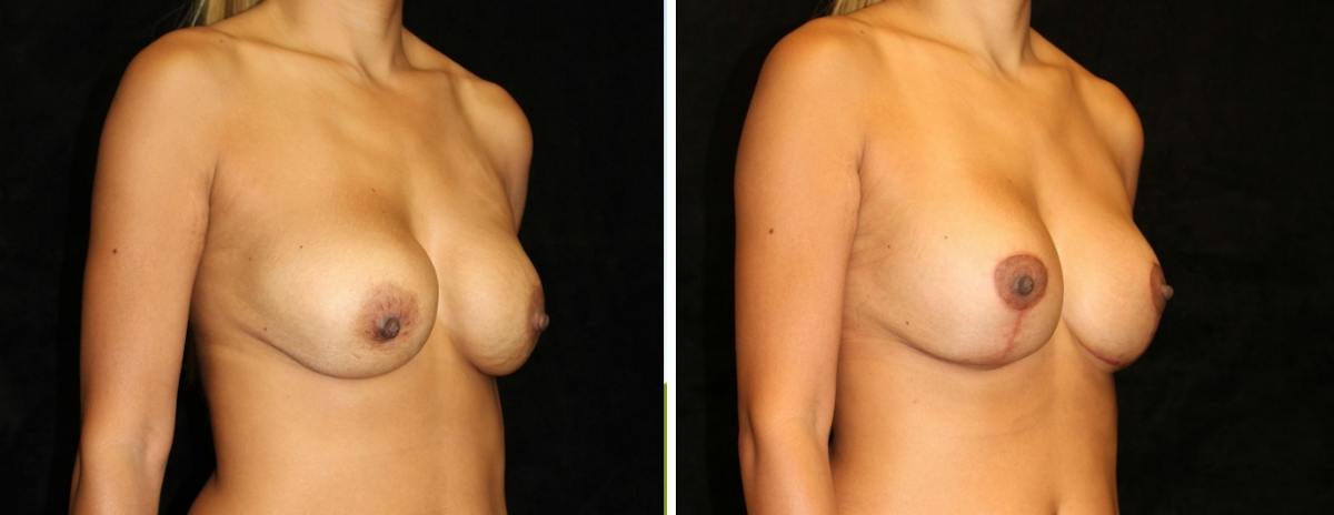 Breast Revision Before & After Gallery - Patient 119741 - Image 2