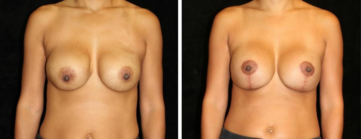 Breast Revision Before & After Gallery - Patient 119741 - Image 1