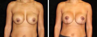Breast Revision Before & After Gallery - Patient 119741 - Image 1