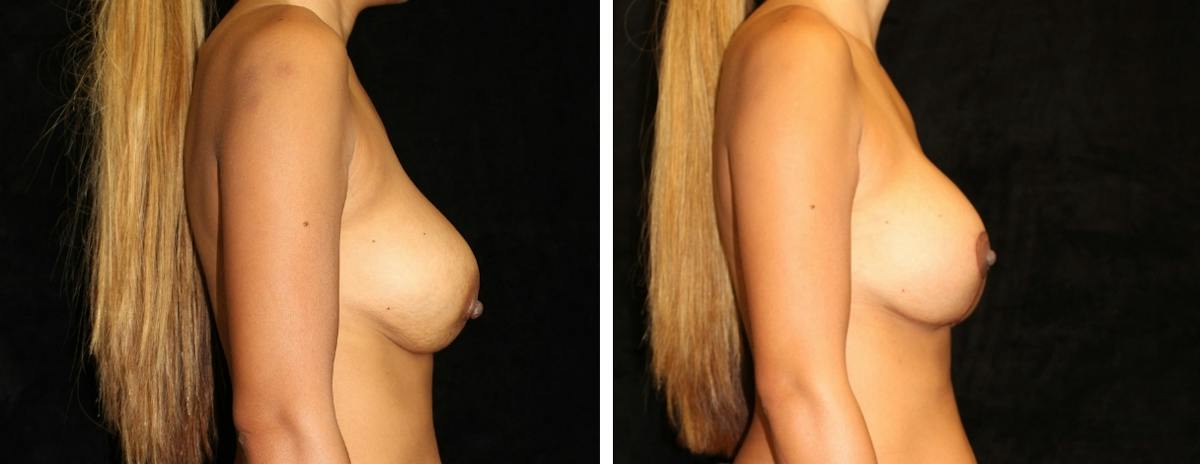 Breast Revision Before & After Gallery - Patient 119741 - Image 3