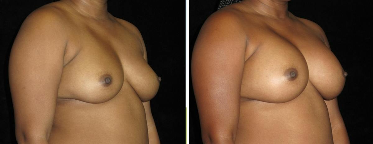 Breast Revision Before & After Gallery - Patient 368610 - Image 2