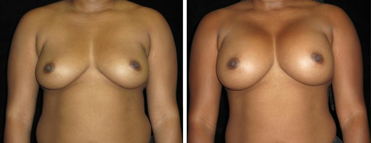 Breast Revision Before & After Gallery - Patient 368610 - Image 1