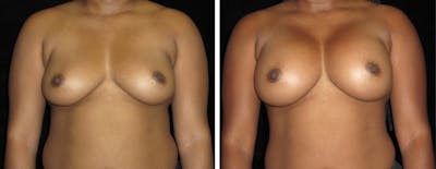 Breast Revision Before & After Gallery - Patient 368610 - Image 1