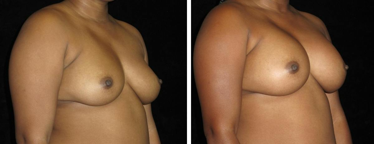 Breast Revision Before & After Gallery - Patient 368610 - Image 3