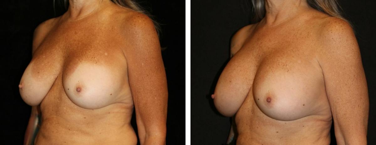 Breast Revision Before & After Gallery - Patient 290567 - Image 2