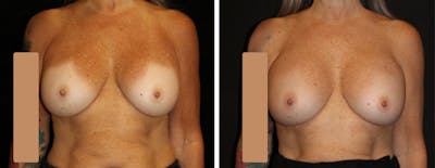 Breast Revision Before & After Gallery - Patient 290567 - Image 1