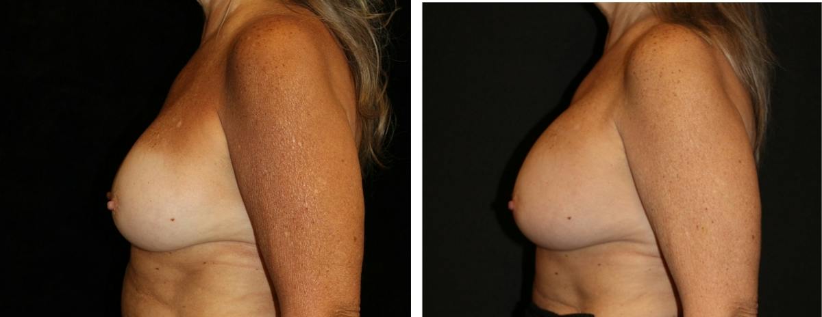 Breast Revision Before & After Gallery - Patient 290567 - Image 3