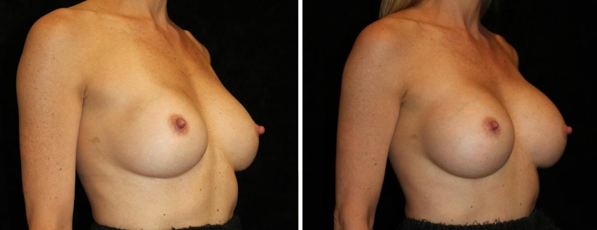 Breast Revision Before & After Gallery - Patient 153900 - Image 2
