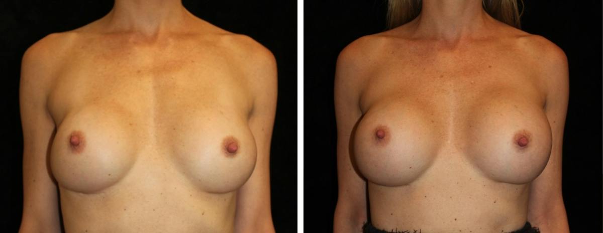 Breast Revision Before & After Gallery - Patient 153900 - Image 1