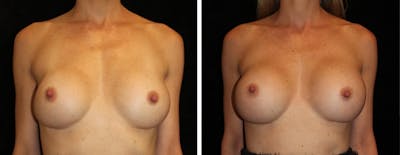 Breast Revision Before & After Gallery - Patient 153900 - Image 1