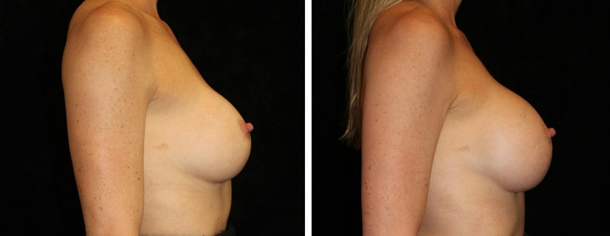 Breast Revision Before & After Gallery - Patient 153900 - Image 3