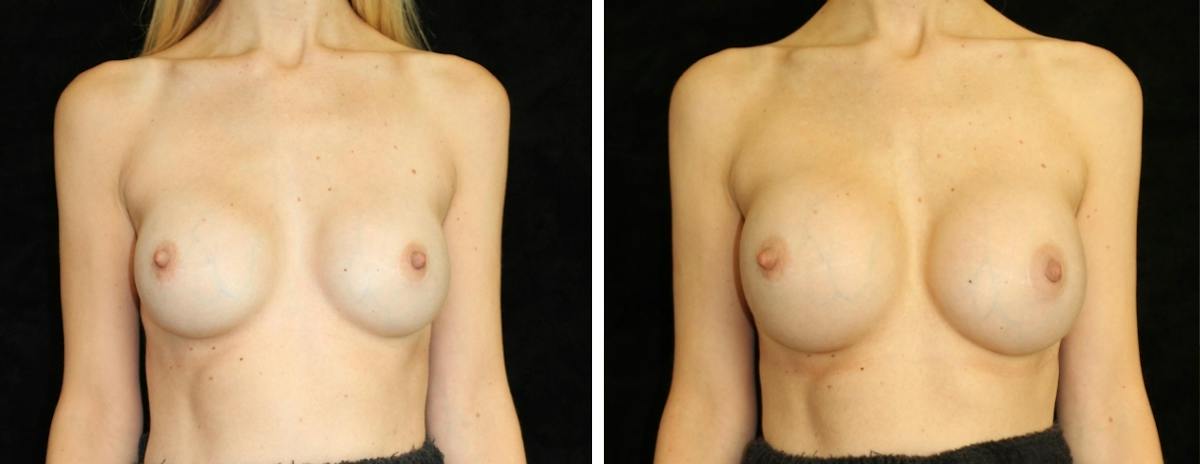 Breast Revision Before & After Gallery - Patient 326358 - Image 1