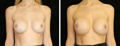 Breast Revision Before & After Gallery - Patient 326358 - Image 1