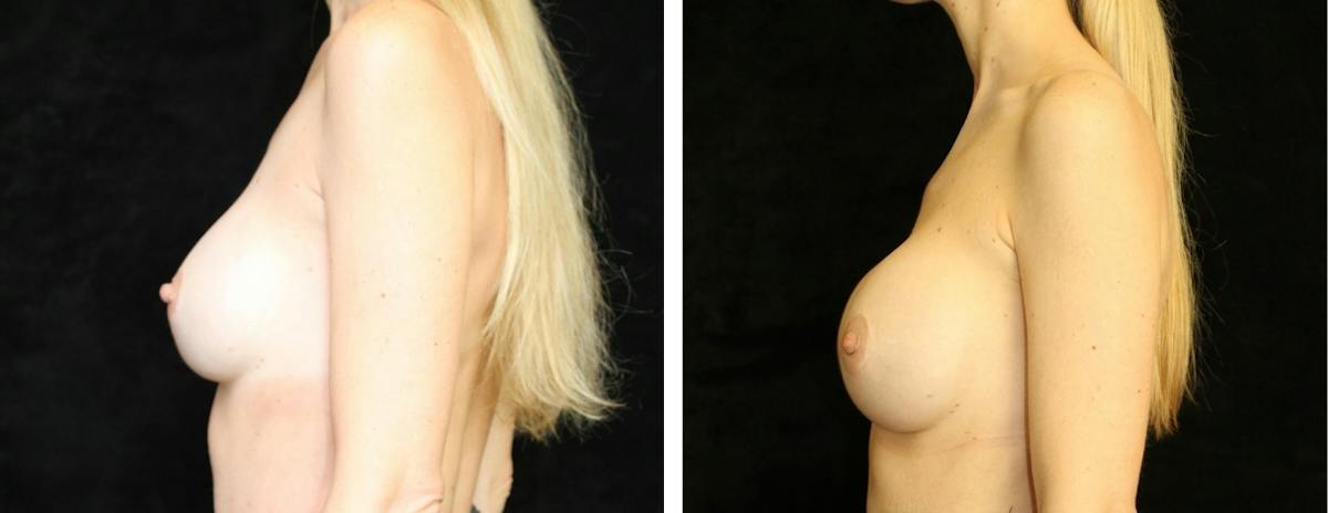 Breast Revision Before & After Gallery - Patient 326358 - Image 3