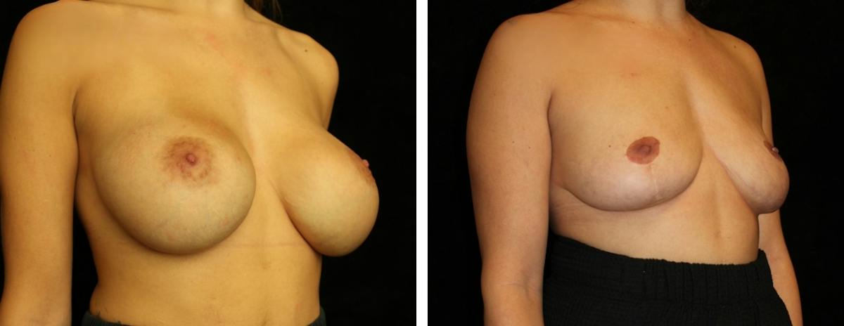 Breast Revision Before & After Gallery - Patient 394164 - Image 2