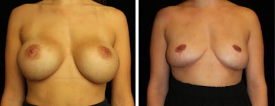 Breast Revision Before & After Gallery - Patient 394164 - Image 1