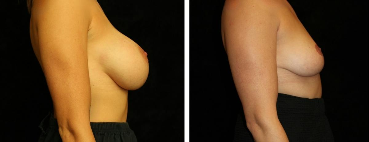 Breast Revision Before & After Gallery - Patient 394164 - Image 3