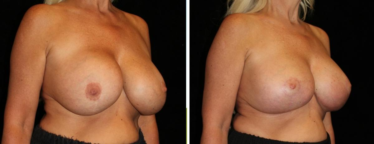Breast Revision Before & After Gallery - Patient 352342 - Image 2