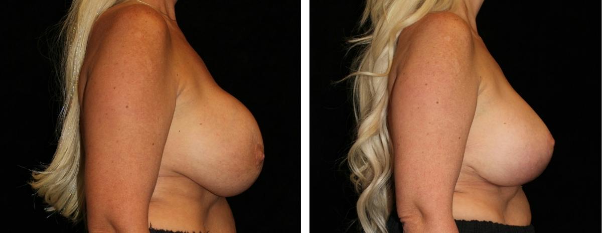 Breast Revision Before & After Gallery - Patient 352342 - Image 3