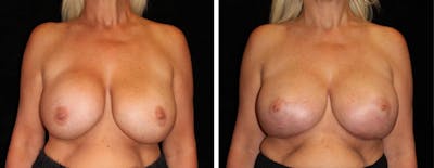 Breast Revision Before & After Gallery - Patient 352342 - Image 1