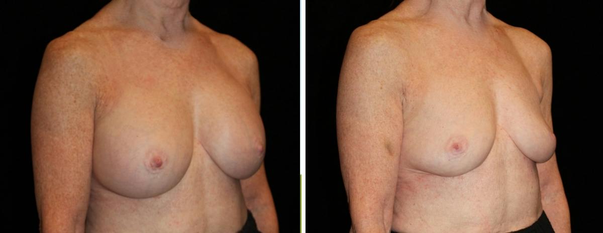 Breast Revision Before & After Gallery - Patient 290333 - Image 2
