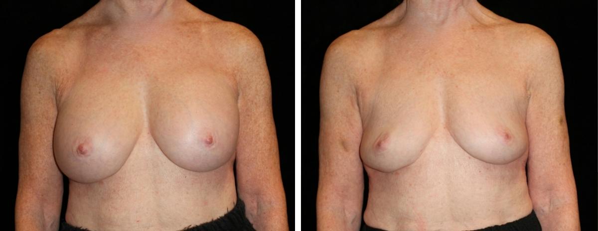 Breast Revision Before & After Gallery - Patient 290333 - Image 1
