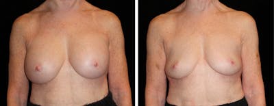 Breast Revision Before & After Gallery - Patient 290333 - Image 1