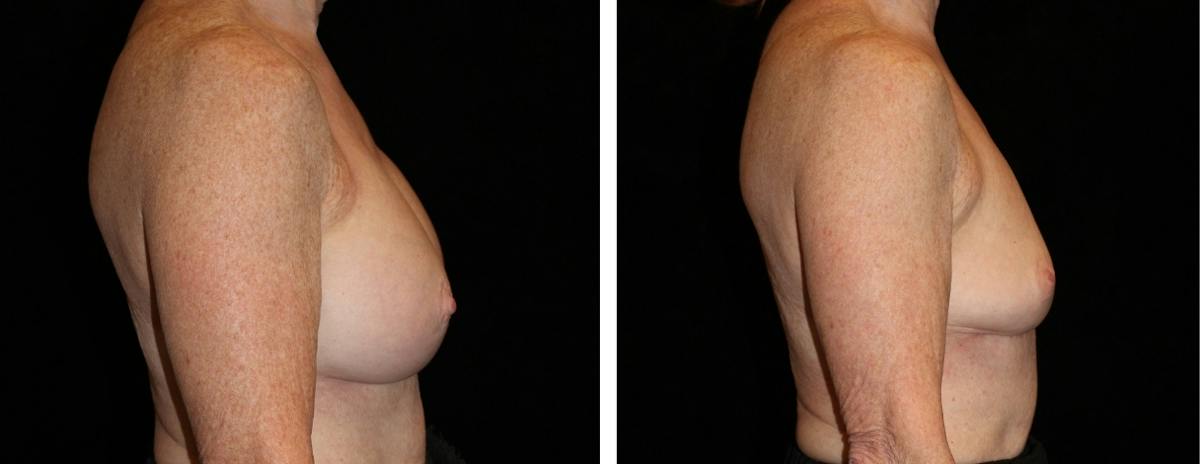 Breast Revision Before & After Gallery - Patient 290333 - Image 3