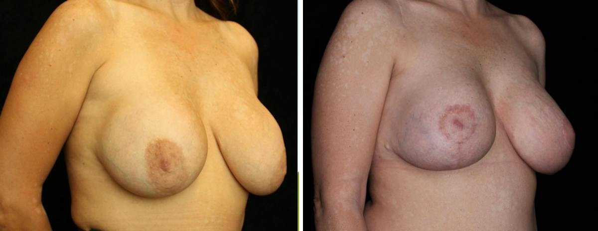 Breast Revision Before & After Gallery - Patient 350621 - Image 2