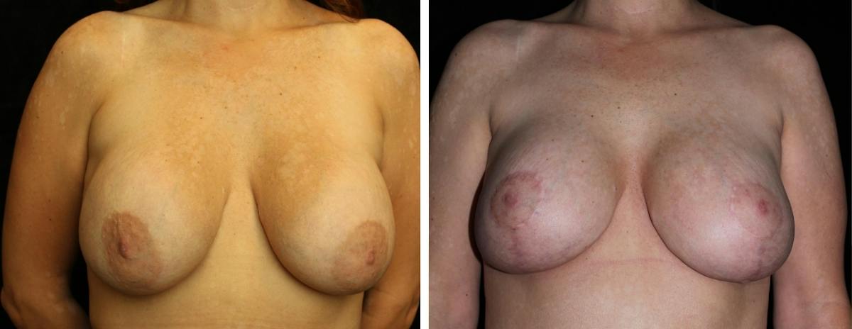 Breast Revision Before & After Gallery - Patient 350621 - Image 1