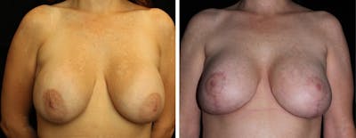 Breast Revision Before & After Gallery - Patient 350621 - Image 1