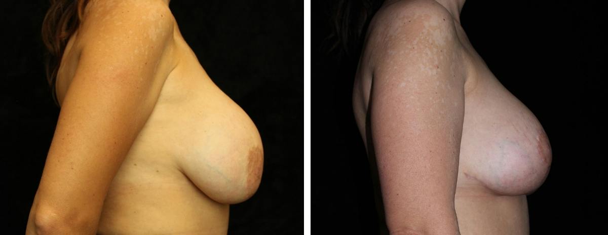 Breast Revision Before & After Gallery - Patient 350621 - Image 3