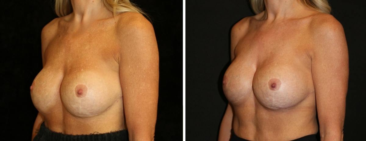 Breast Revision Before & After Gallery - Patient 104031 - Image 2