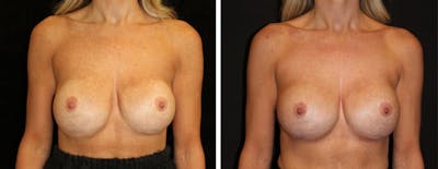 Breast Revision Before & After Gallery - Patient 104031 - Image 1