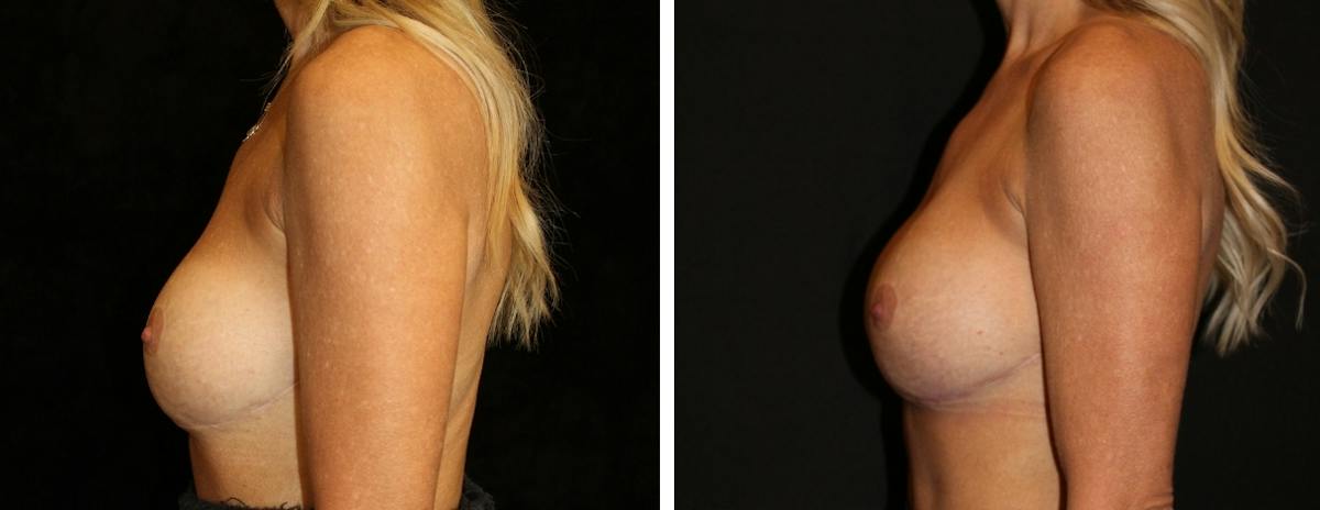 Breast Revision Before & After Gallery - Patient 104031 - Image 3