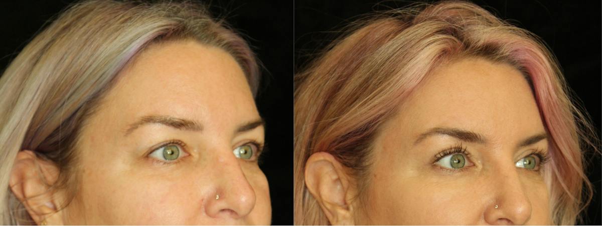 Eyelid Surgery Before & After Gallery - Patient 298681 - Image 2