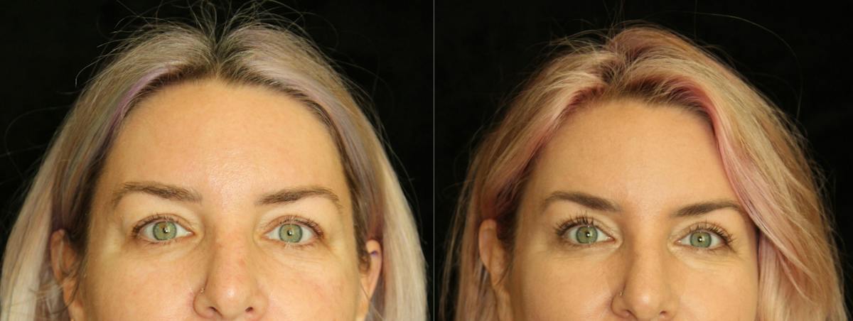 Eyelid Surgery Before & After Gallery - Patient 298681 - Image 1