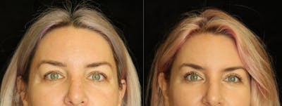 Eyelid Surgery Before & After Gallery - Patient 298681 - Image 1