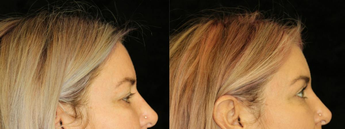 Eyelid Surgery Before & After Gallery - Patient 298681 - Image 3
