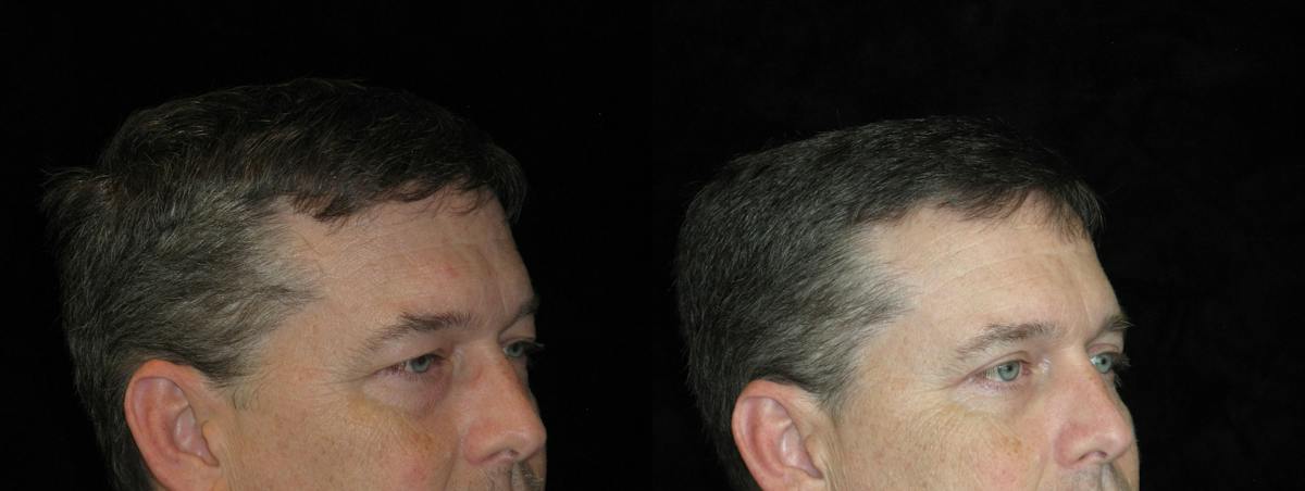 Eyelid Surgery Before & After Gallery - Patient 297950 - Image 2