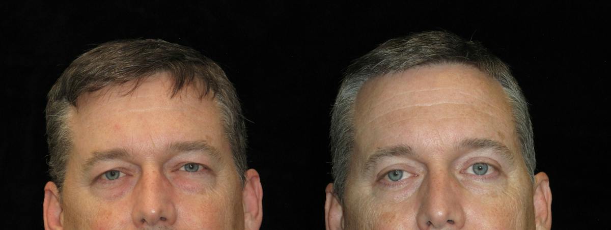 Eyelid Surgery Before & After Gallery - Patient 297950 - Image 1