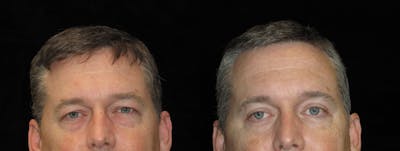 Eyelid Surgery Before & After Gallery - Patient 297950 - Image 1