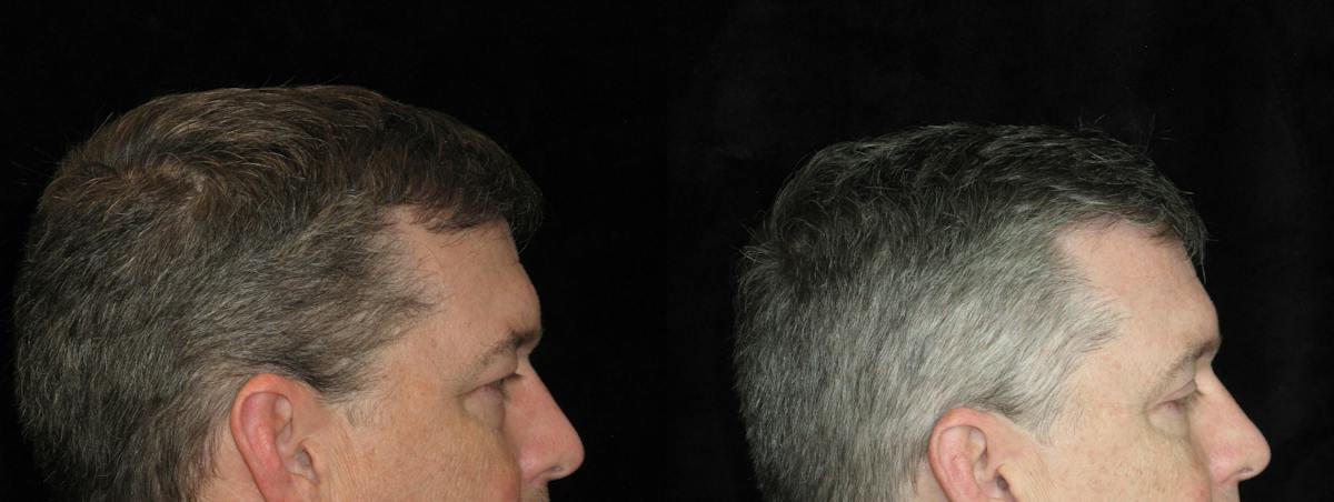 Eyelid Surgery Before & After Gallery - Patient 297950 - Image 3