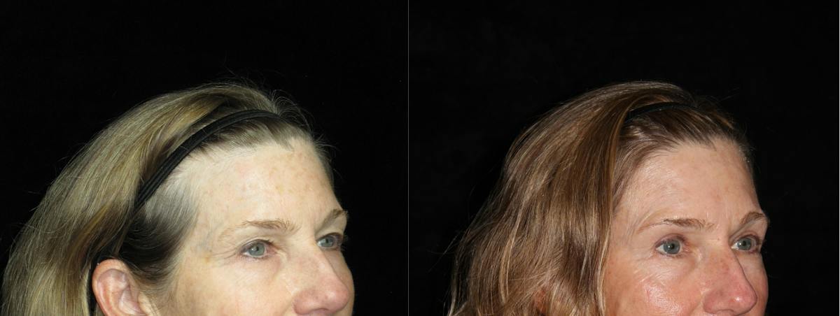 Eyelid Surgery Before & After Gallery - Patient 334558 - Image 2