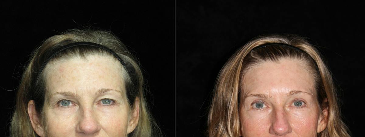 Eyelid Surgery Before & After Gallery - Patient 334558 - Image 1